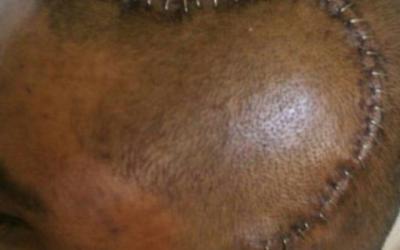 50 stitches on the head, cancerous tumor- healed by Jesus!!!